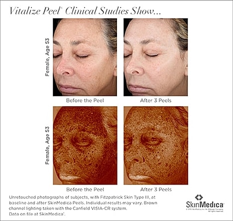 Vitalize Peel results before and after treatment.