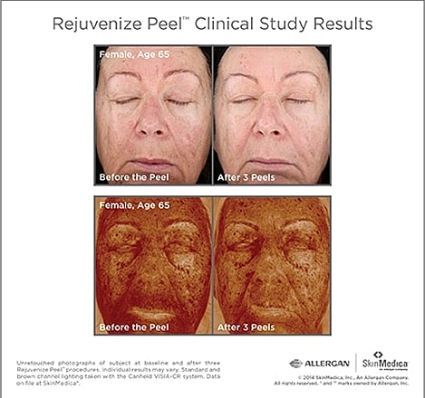 Before and after Rejuvenize Peel treatment results