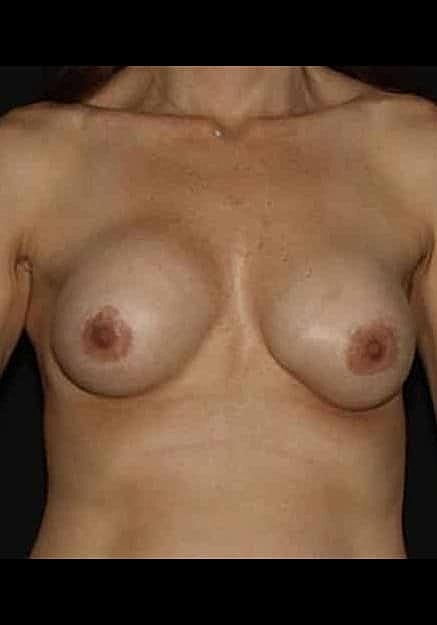 Breast Implant Revision Before & After