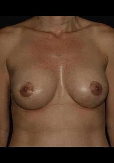 Breast Implant Revision Before & After