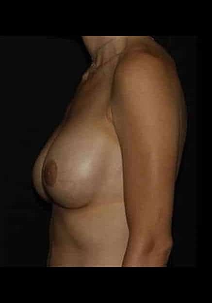 Breast Implant Revision Before & After