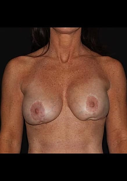 Breast Implant Revision Before & After