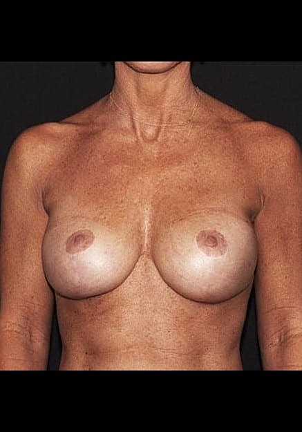 Breast Implant Revision Before & After