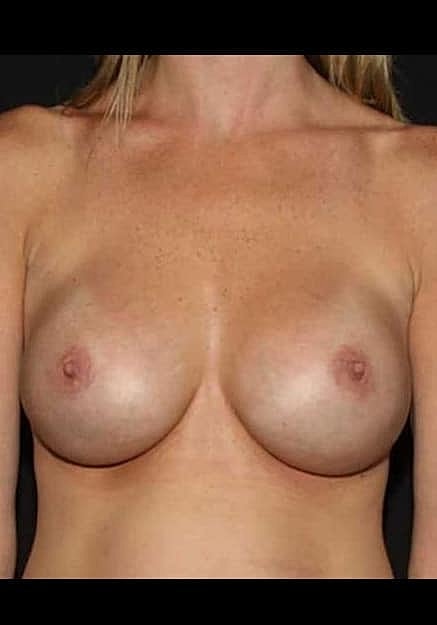 Breast Implant Revision Before & After