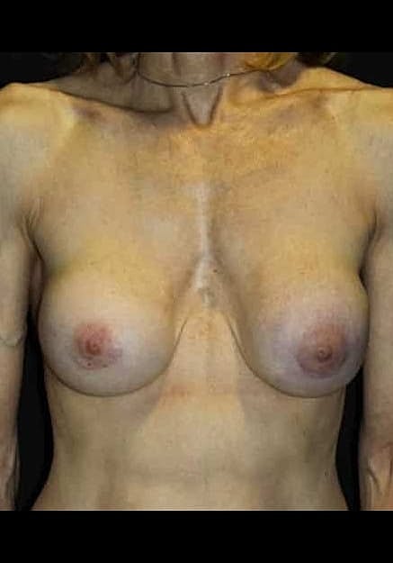Breast Implant Revision Before & After