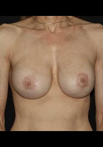 Breast Implant Revision Before & After