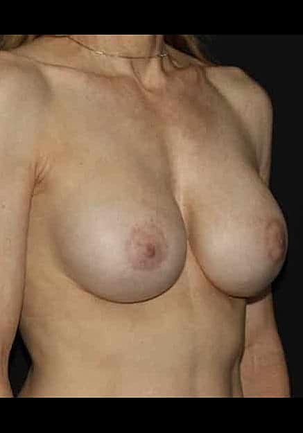 Breast Implant Revision Before & After