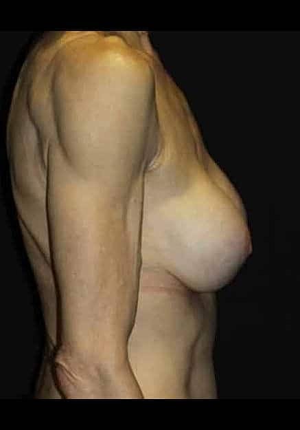 Breast Implant Revision Before & After