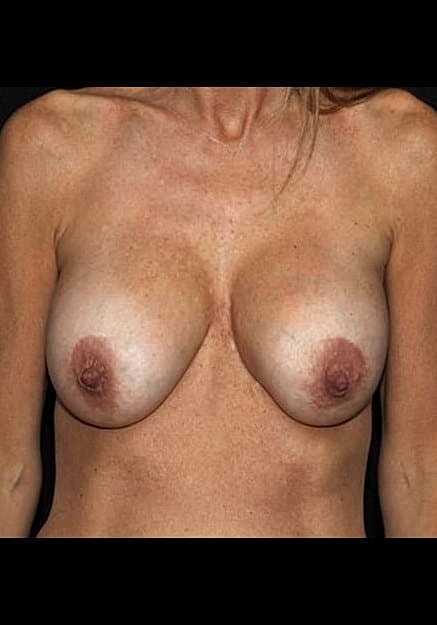Breast Implant Revision Before & After