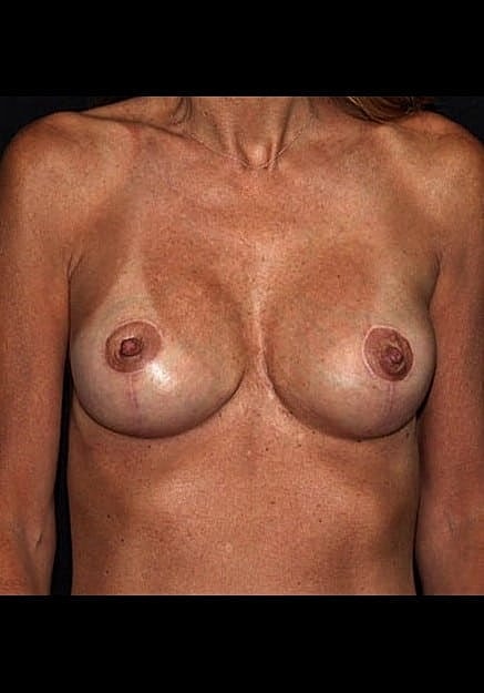 Breast Implant Revision Before & After