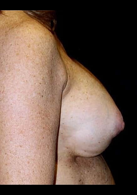 Breast Implant Revision Before & After