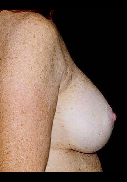 Breast Implant Revision Before & After