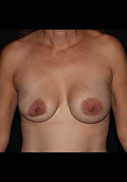 Breast Implant Revision Before & After