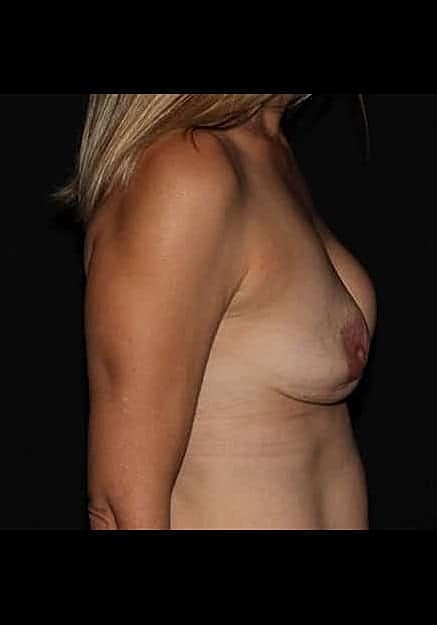 Breast Implant Revision Before & After