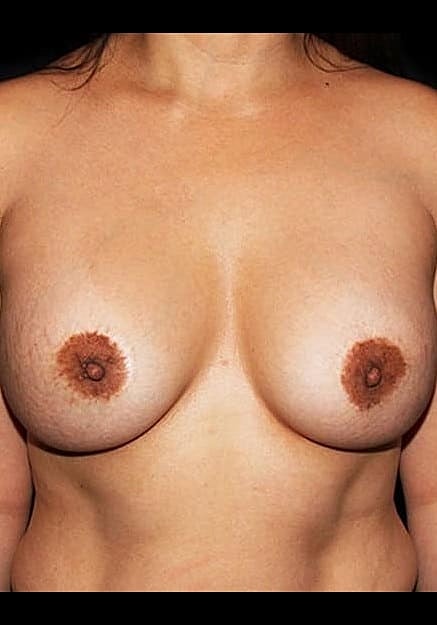 Breast Implant Revision Before & After