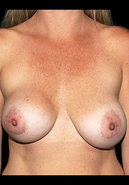 Breast Implant Revision Before & After