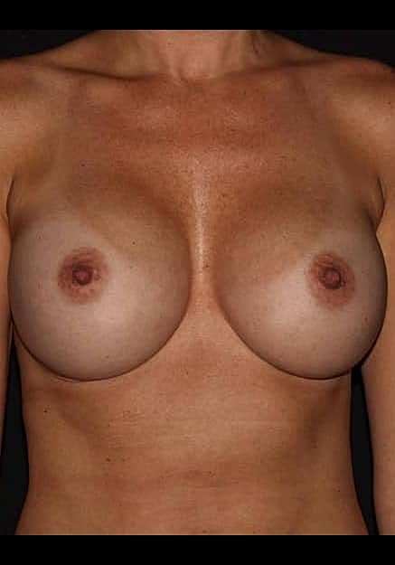 Breast Implant Revision Before & After