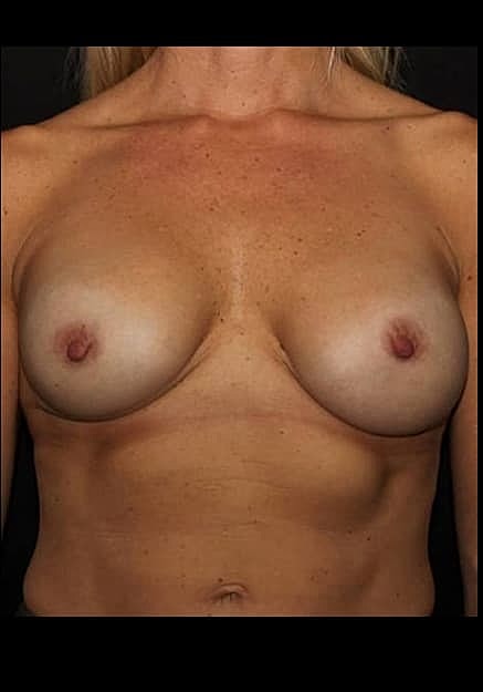 Breast Implant Revision Before & After