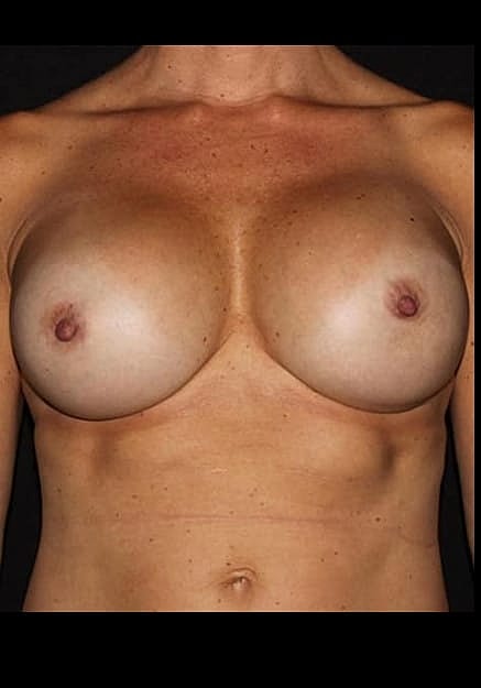 Breast Implant Revision Before & After