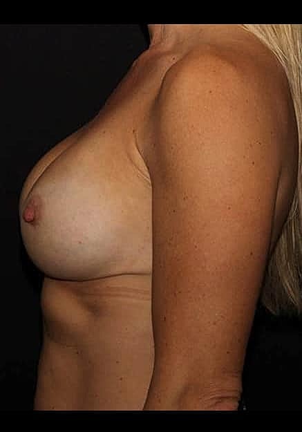 Breast Implant Revision Before & After