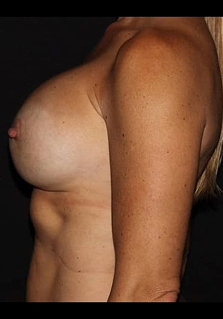 Breast Implant Revision Before & After