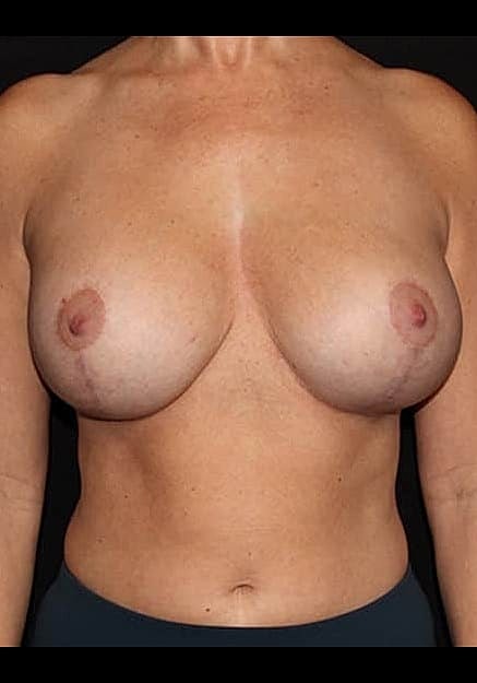Breast Implant Revision Before & After