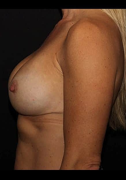 Breast Implant Revision Before & After