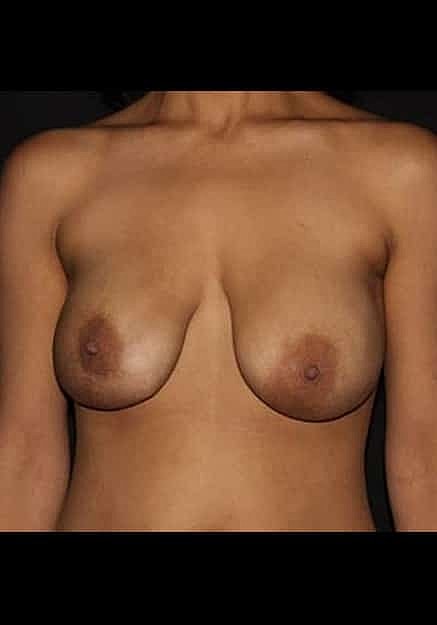 Breast Implant Revision Before & After