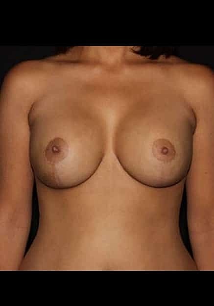 Breast Implant Revision Before & After