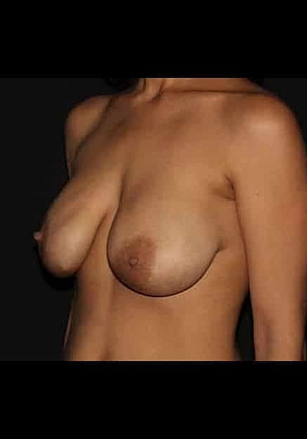 Breast Implant Revision Before & After