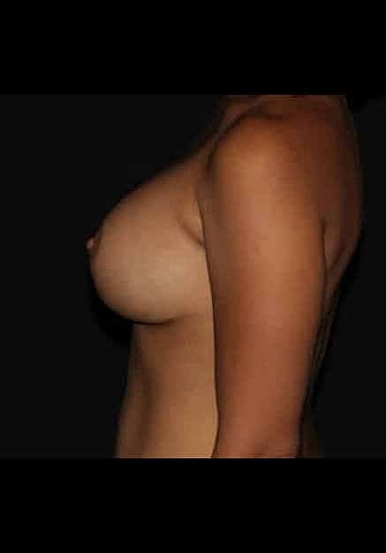 Breast Implant Revision Before & After