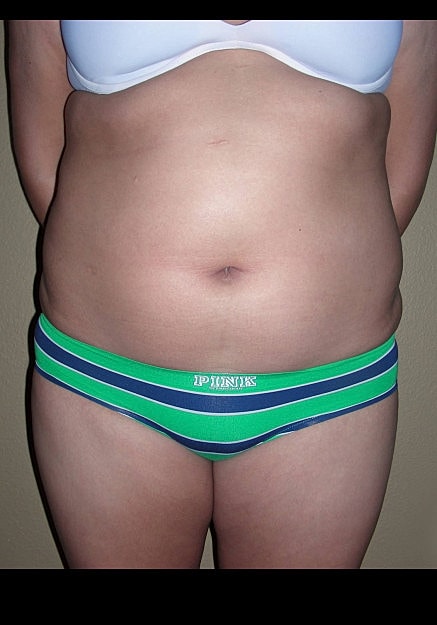 Liposuction Before & After