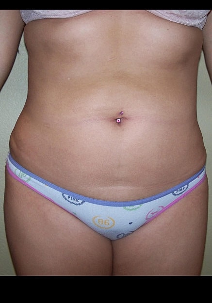 Liposuction Before & After