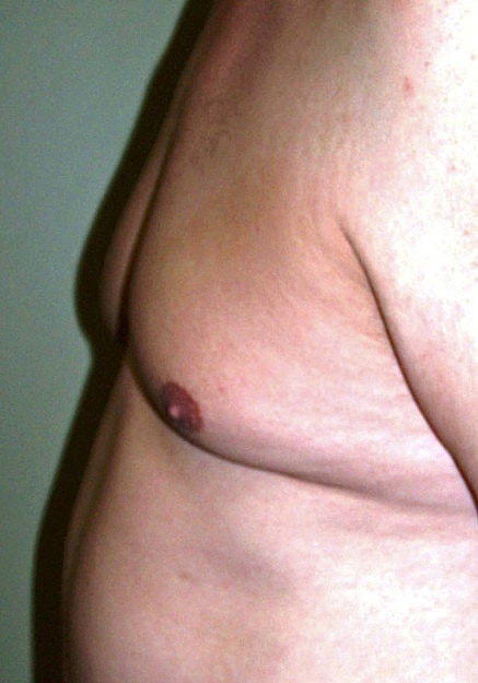 Male Breast Reduction Before & After