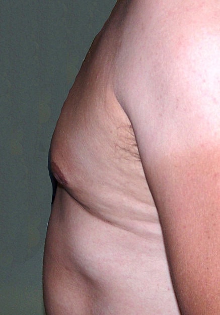Male Breast Reduction Before & After