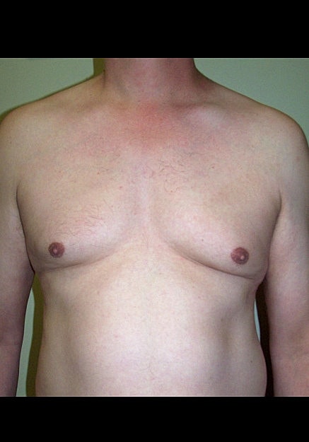 Male Breast Reduction Before & After