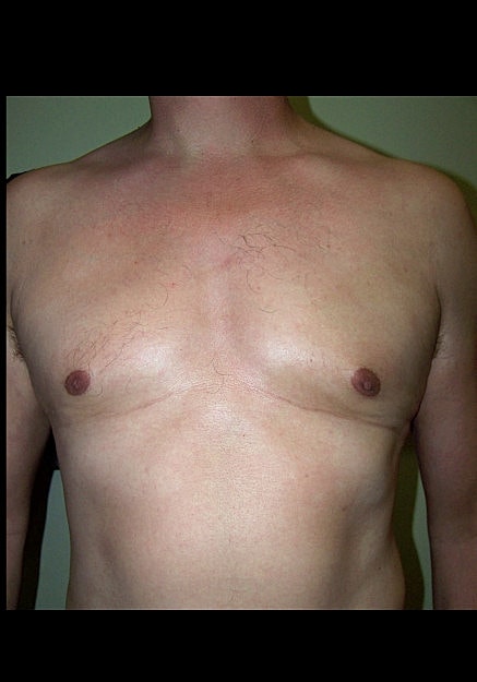 Male Breast Reduction Before & After