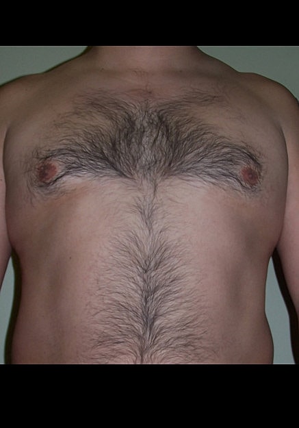 Male Breast Reduction Before & After