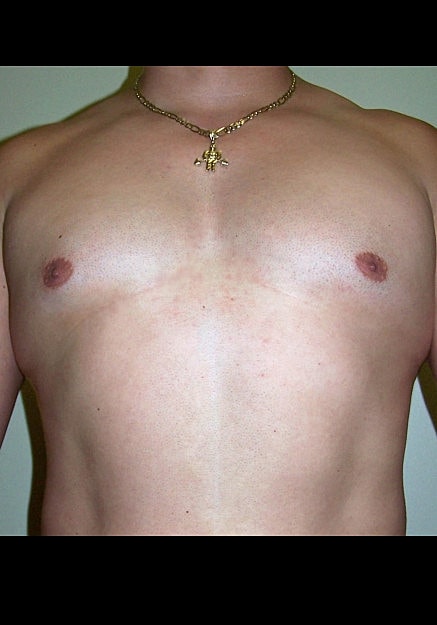 Male Breast Reduction Before & After