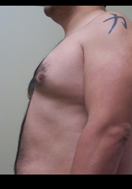 Male Breast Reduction Before & After