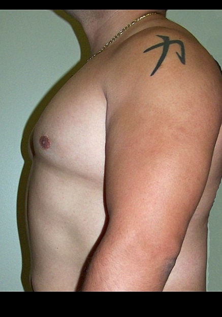 Male Breast Reduction Before & After