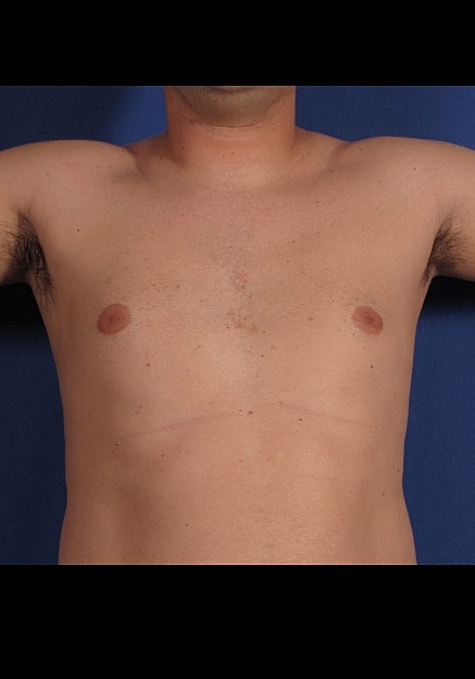 Male Breast Reduction Before & After