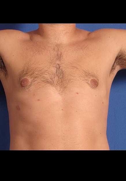 Male Breast Reduction Before & After