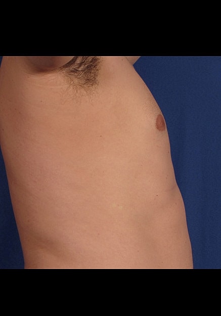 Male Breast Reduction Before & After