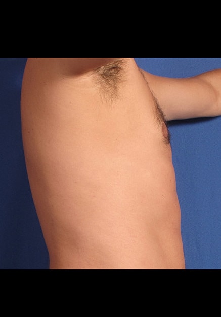 Male Breast Reduction Before & After