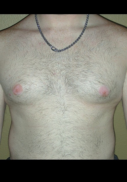 Male Breast Reduction Before & After