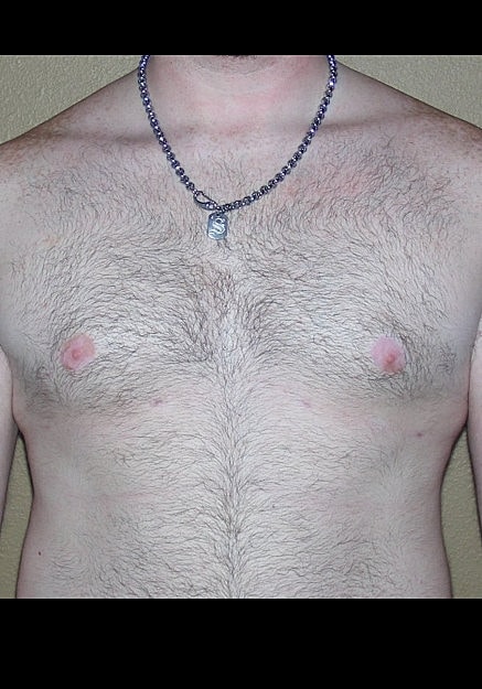 Male Breast Reduction Before & After