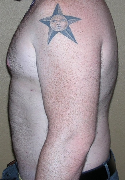 Male Breast Reduction Before & After