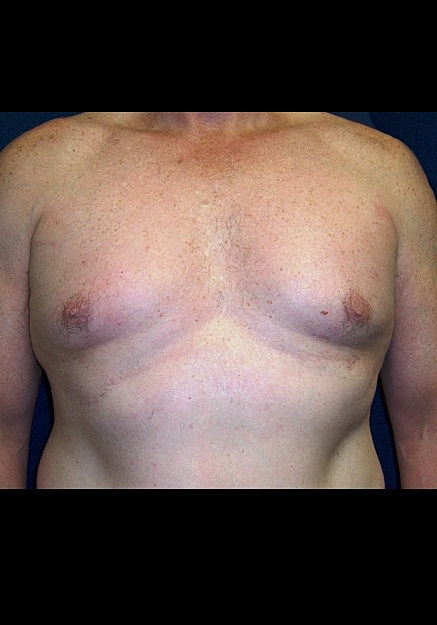 Male Breast Reduction Before & After