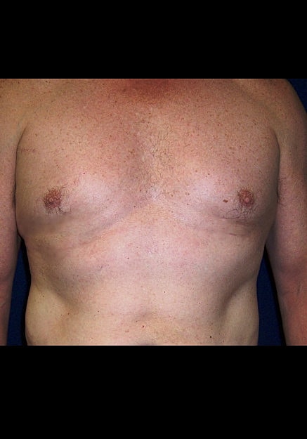 Male Breast Reduction Before & After